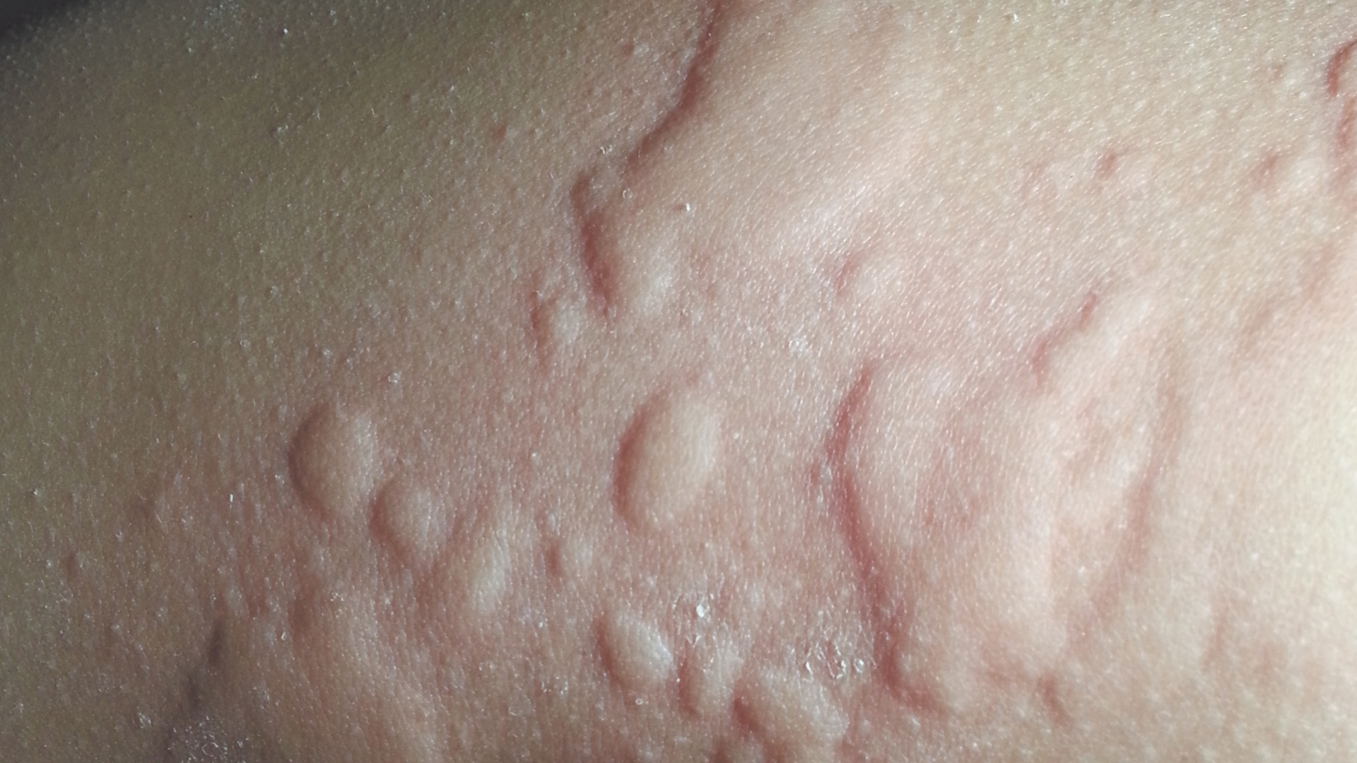 Triệu chứng dị ứng hạnh nhân có thể khác nhau ở mỗi người