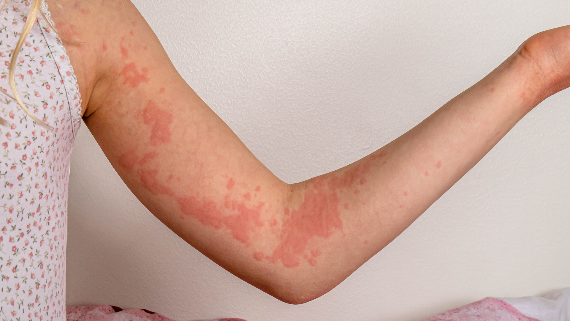 Dị ứng nước: Căn bệnh hiếm gặp gây nổi mề đay khi tiếp xúc với nước 2