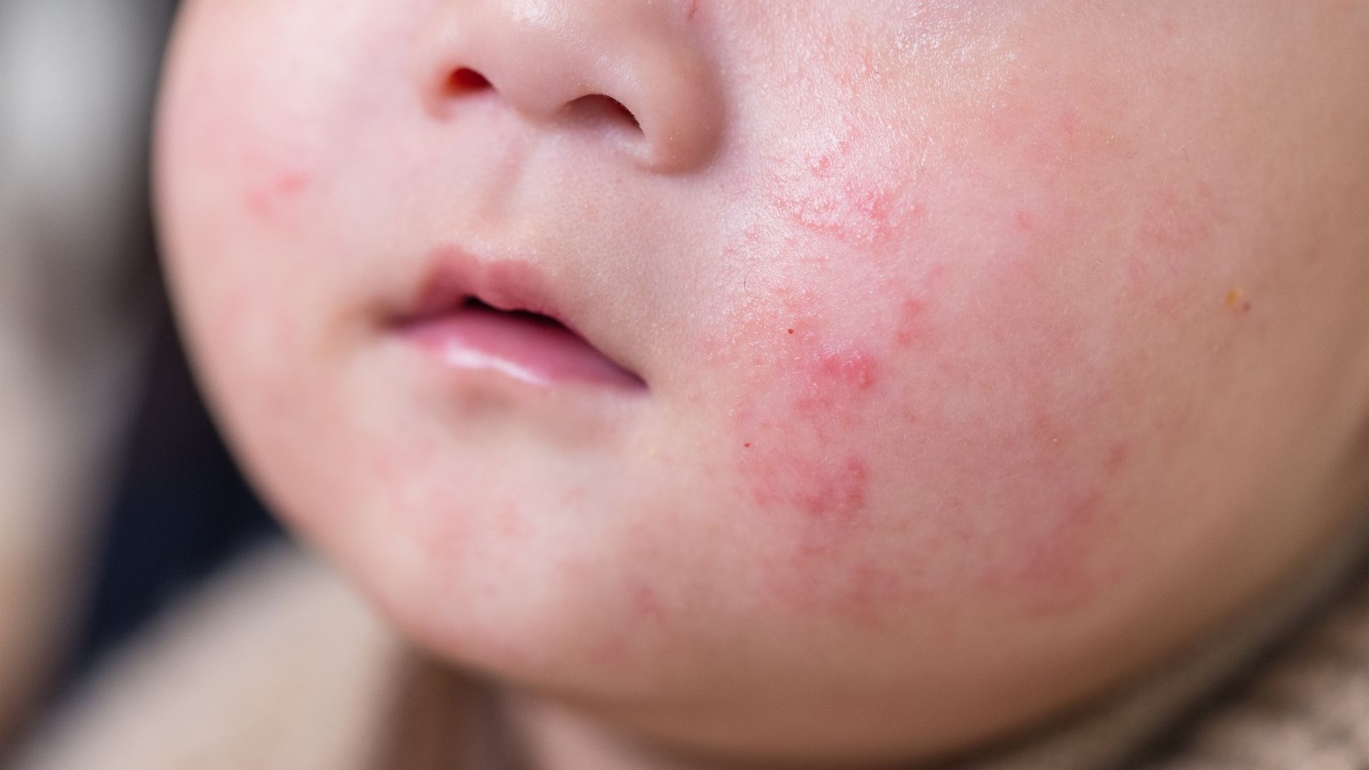 Dị ứng sữa mẹ ở trẻ sơ sinh: Dấu hiệu nhận biết, nguyên nhân và cách xử lý an toàn 2