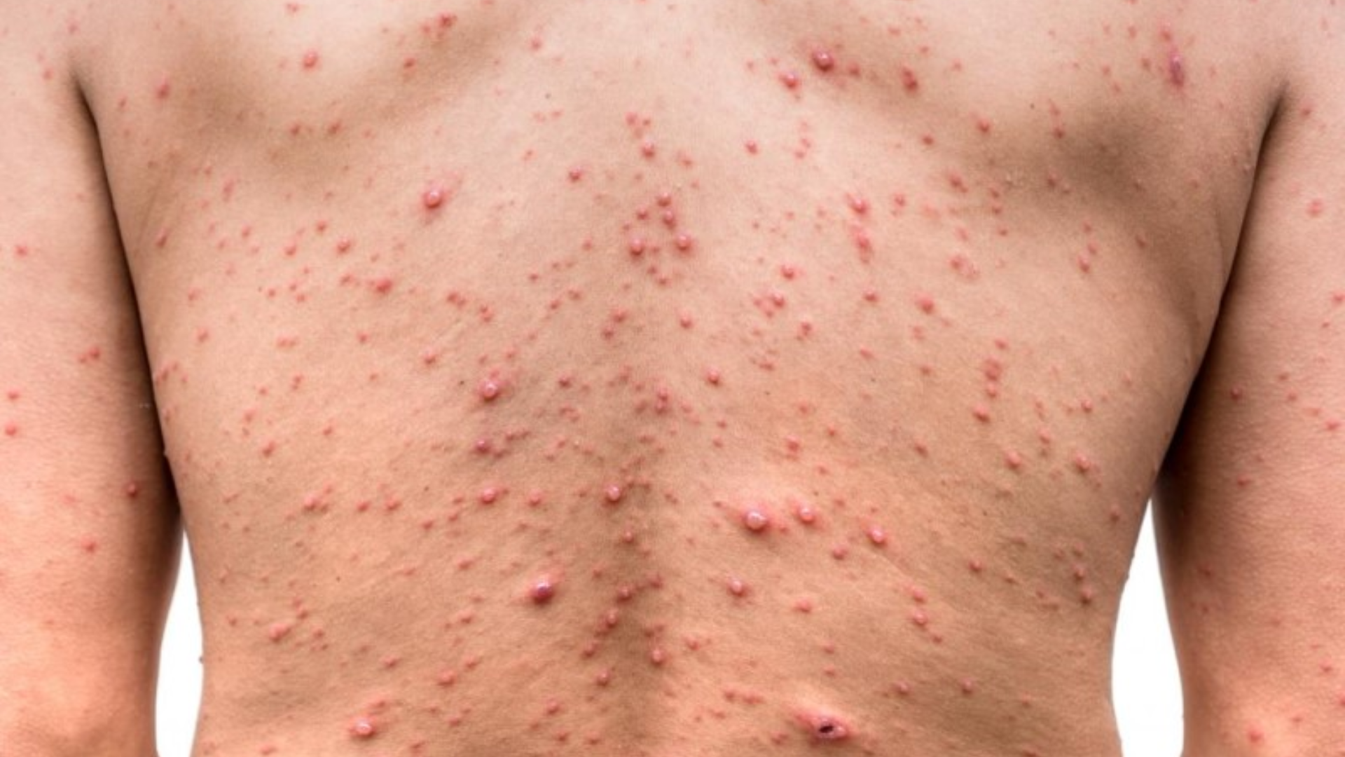 dien-bien-cua-mun-thuy-dau-va-cach-cham-soc-hieu-qua-3