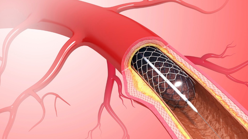 Điều trị nhồi máu cơ tim: Chẩn đoán, phác đồ và phòng ngừa tái phát 3