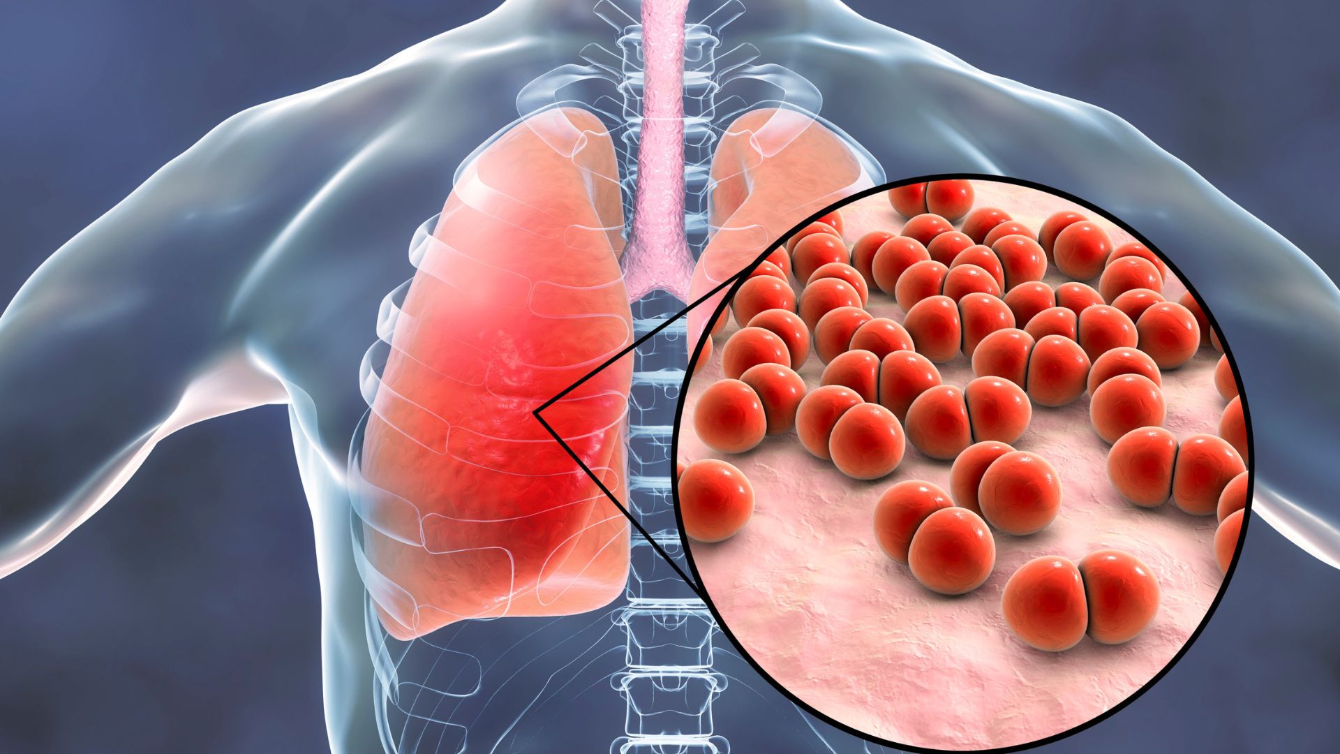 Điều trị viêm phổi do phế cầu khuẩn: Giải pháp hiệu quả từ y học hiện đại 1