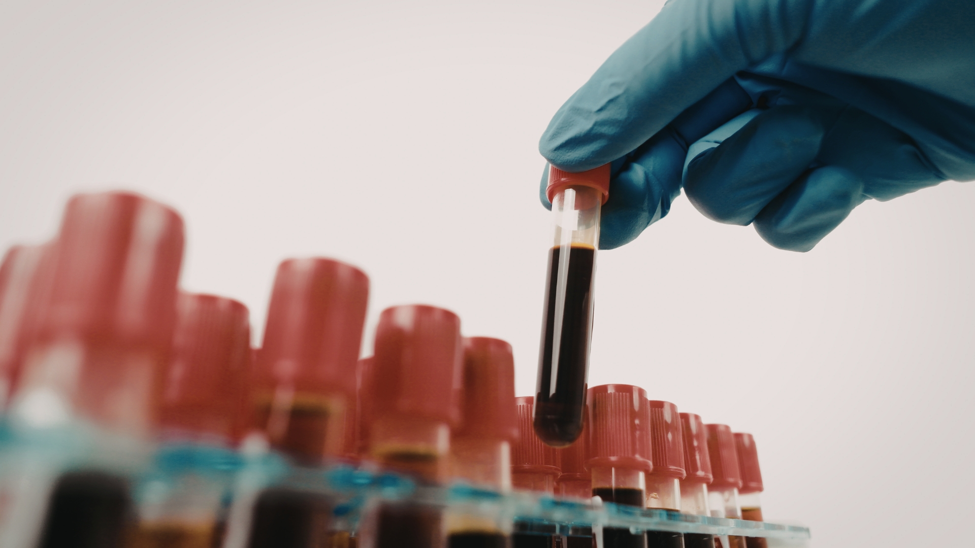 Xét nghiệm FT3 thường có kết quả chính xác hơn trong một vài trường hợp vì FT3 ít bị ảnh hưởng bởi các protein trong máu