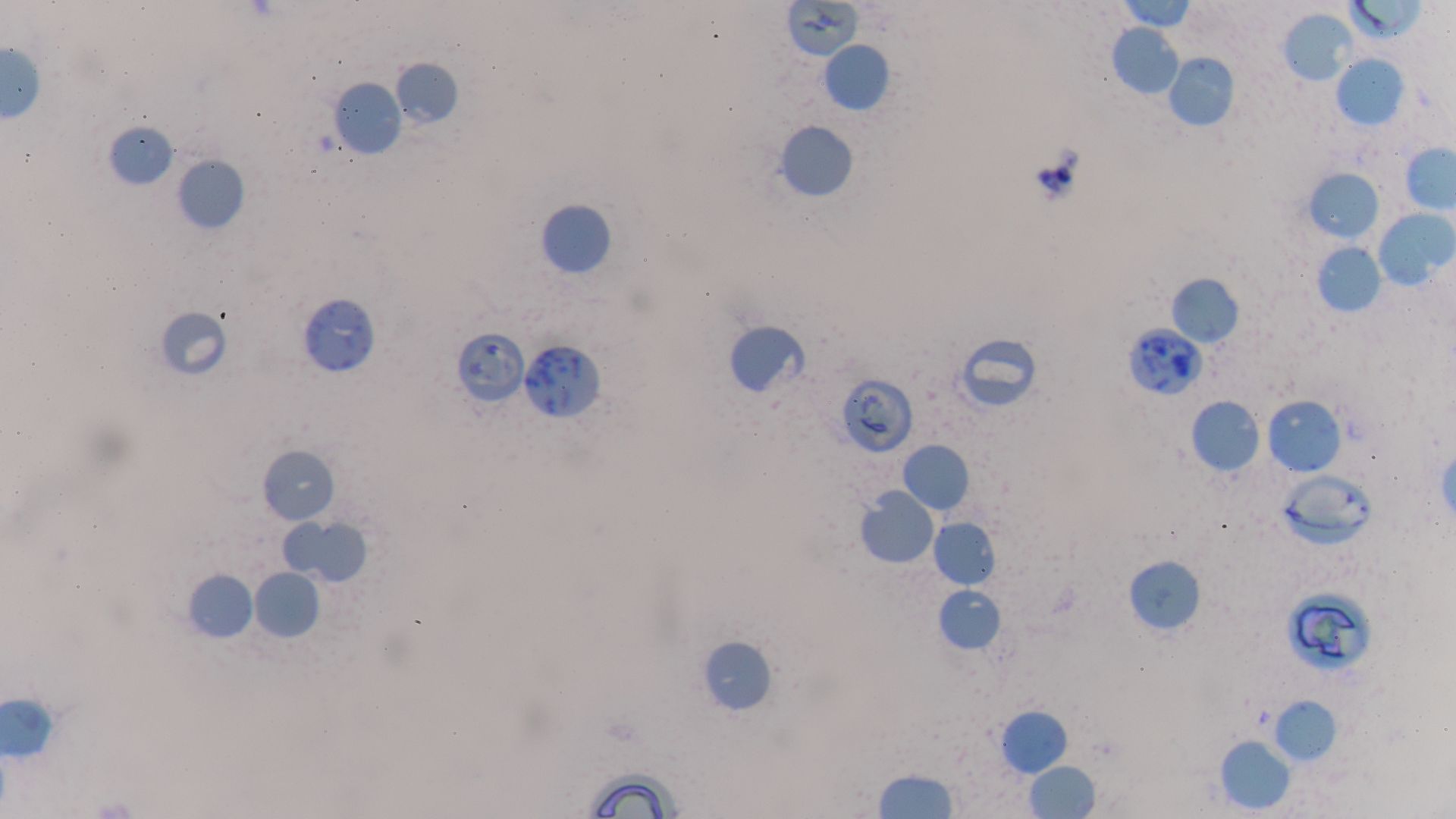 Bác sĩ thường kết hợp song song xét nghiệm nồng độ Haptoglobin và hồng cầu lưới trong chẩn đoán và theo dõi tiến triển bệnh