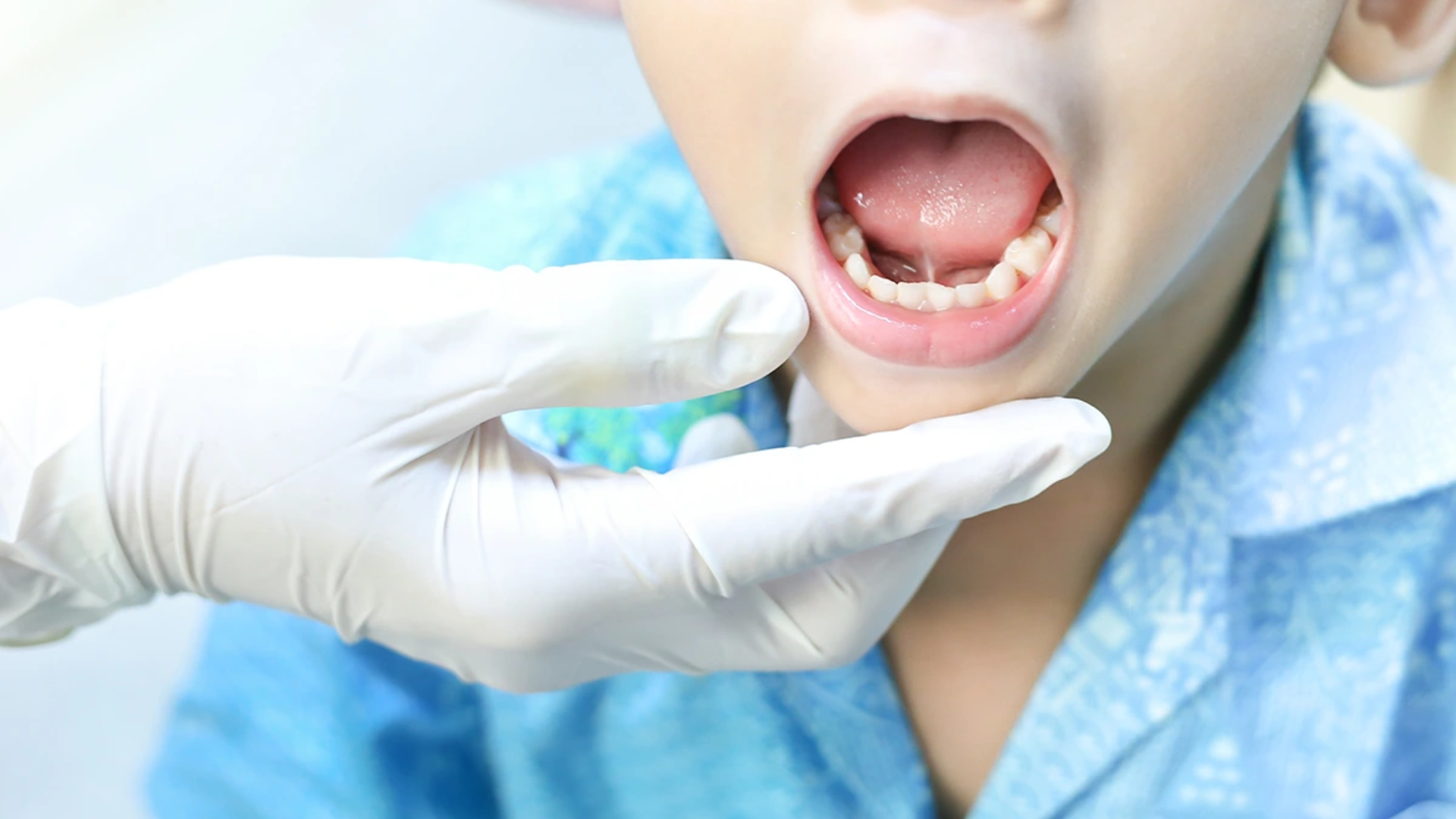 Dính thắng lưỡi nhẹ ở trẻ em có đáng lo không? Khi nào cần can thiệp? 2