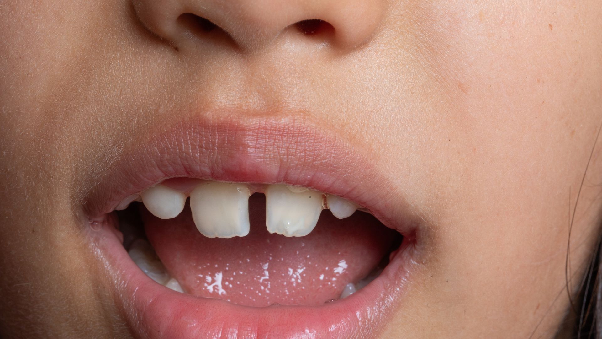 Dính thắng môi trên còn ảnh hưởng đến quá trình mọc răng, gây kém thẩm mỹ