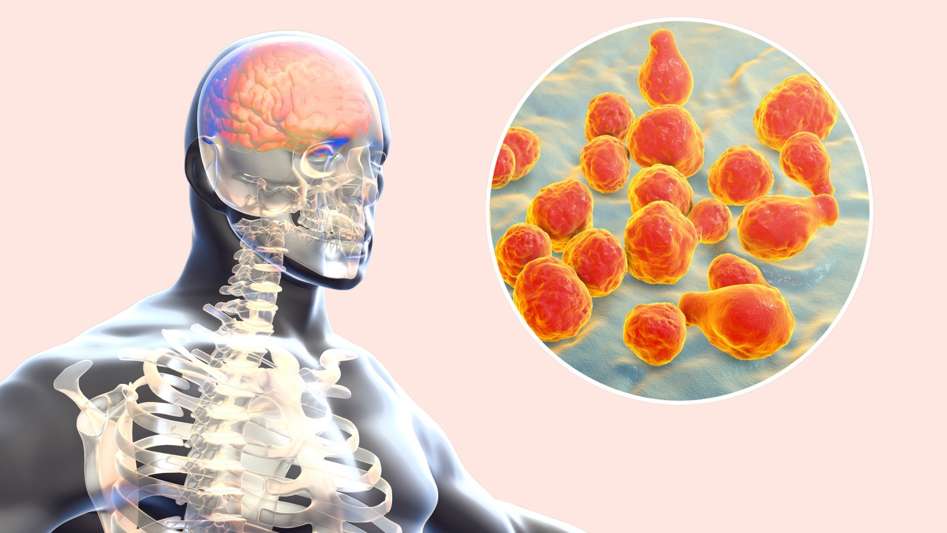 Viêm màng não mủ xảy ra khi lớp màng bao quanh não và tủy sống bị vi khuẩn tấn công, gây viêm và tích tụ mủ