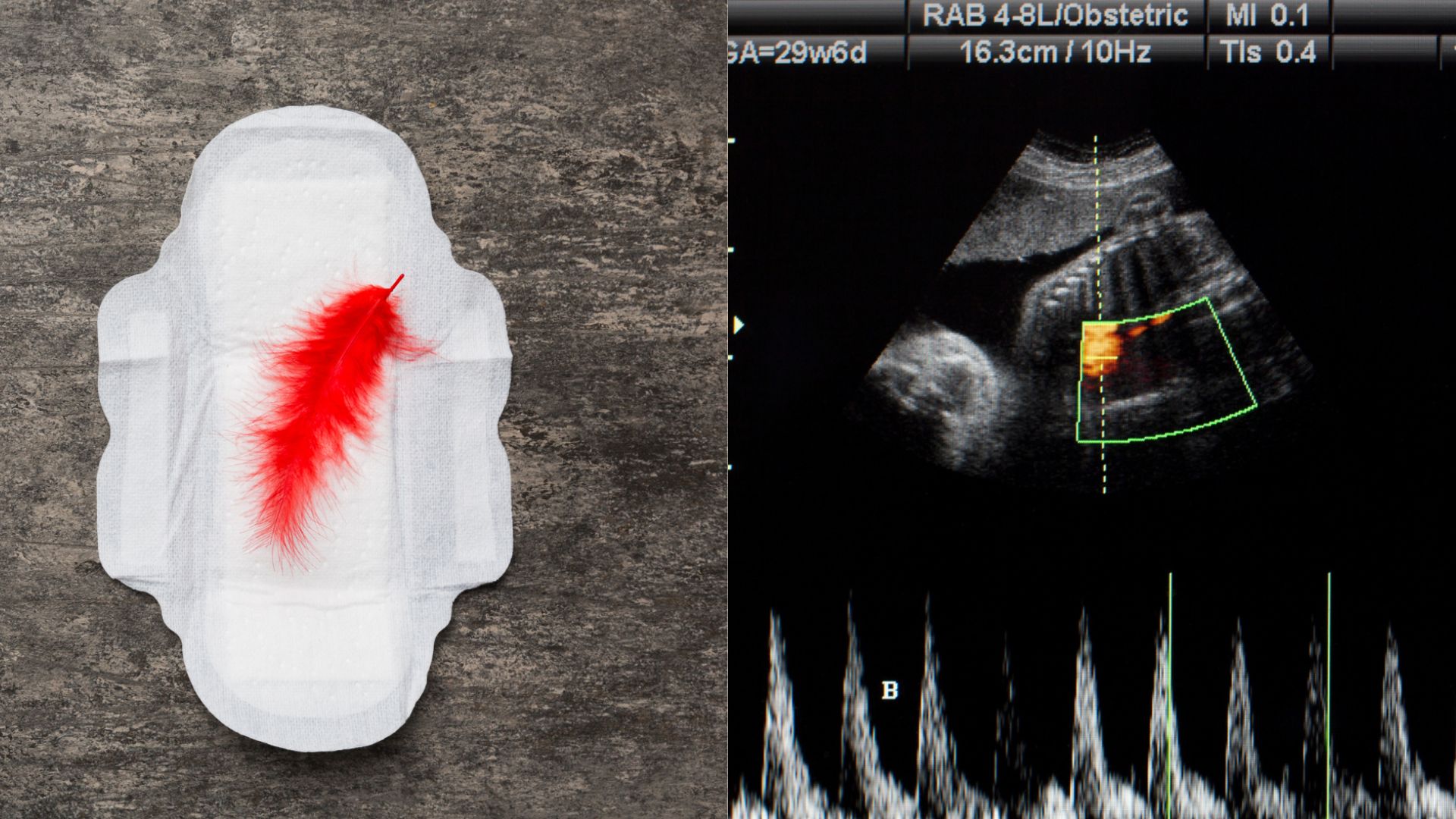 Dọa sảy thai sẽ rất nguy hiểm nếu tim thai yếu dần và mẹ bầu ra nhiều máu