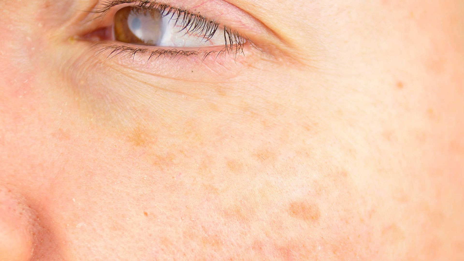 Đồi mồi là tình trạng mà không ít chị em phái đẹp đã và đang phải đối mặt