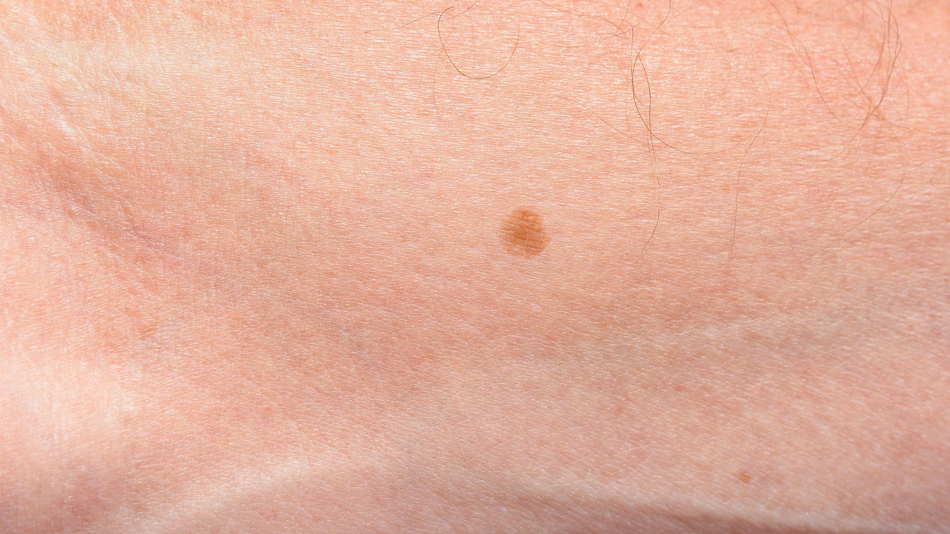 Vết đồi mồi thường có hình tròn hoặc bầu dục và có màu sắc tương đối đồng nhất