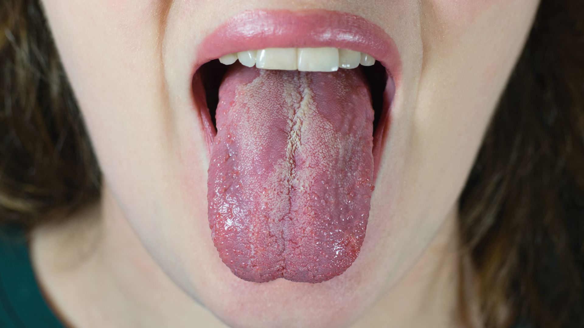 Nhiễm nấm miệng là một nguyên nhân gây ra đốm đỏ trên lưỡi