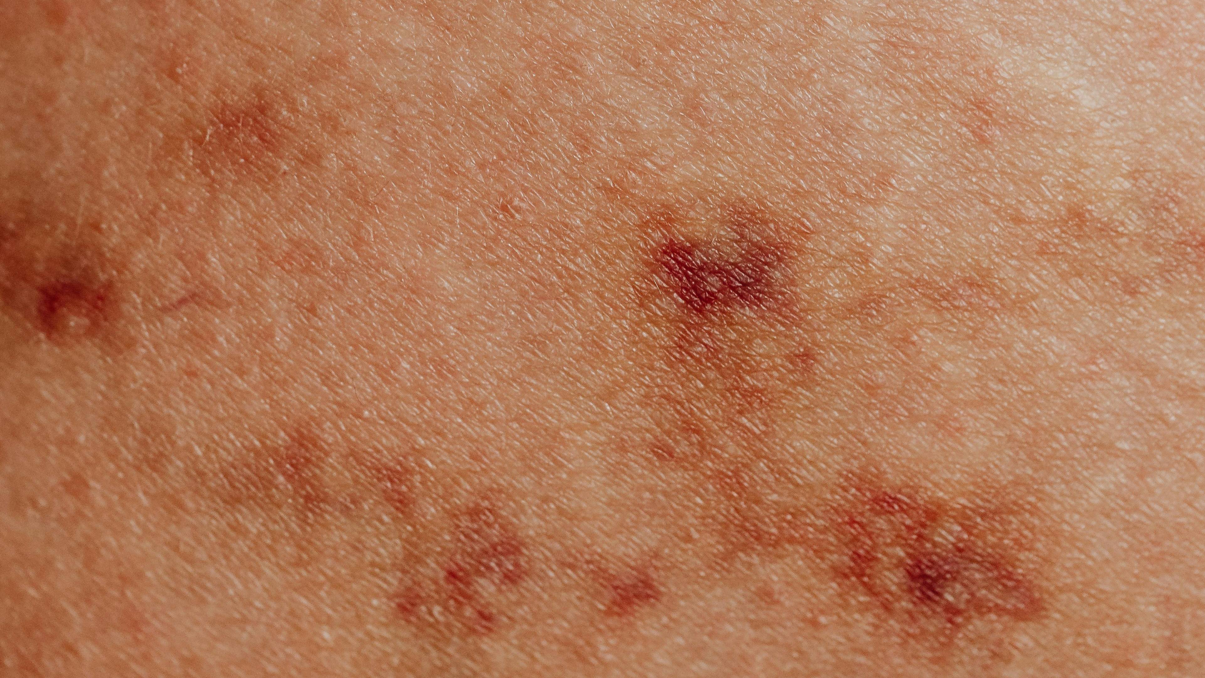 Nguyên nhân gây tăng sắc tố dẫn đến đốm nâu có thể do tác động của viêm da