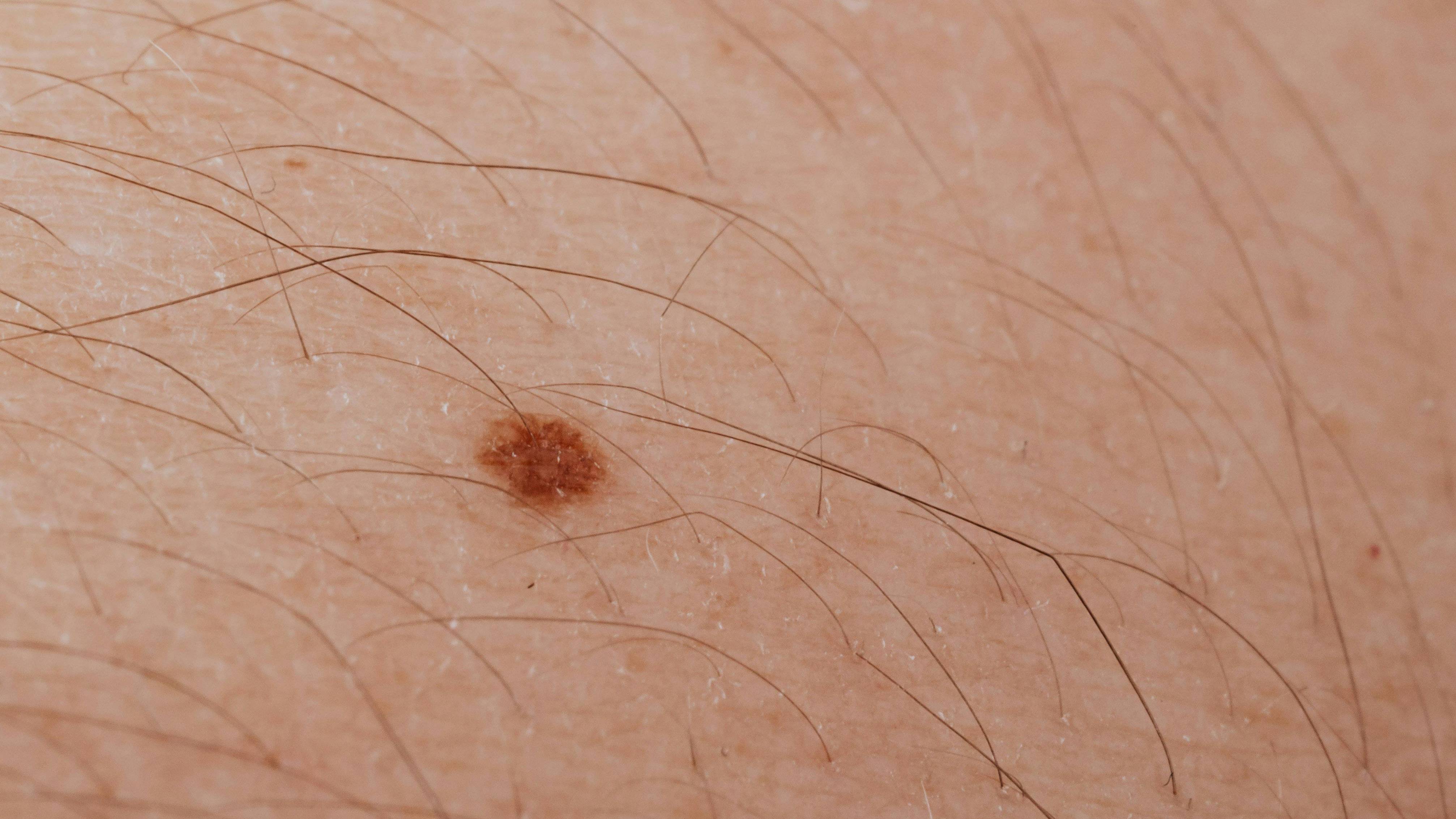 Một dấu hiệu cho thấy da đang bị tăng sắc tố là xuất hiện các đốm phẳng có dạng tròn hoặc bầu dục