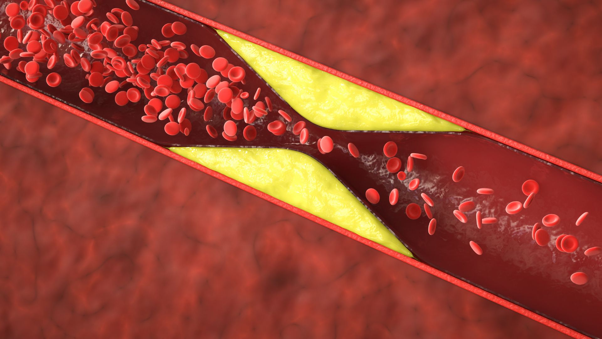 Xơ vữa động mạch là một bệnh lý thường gặp liên quan đến động mạch