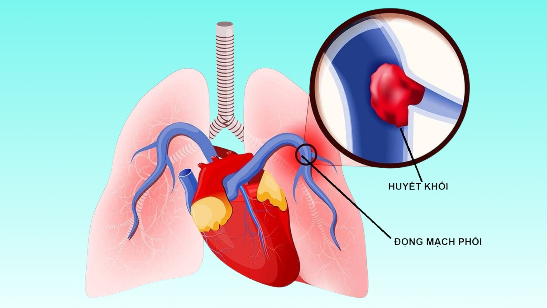 Động mạch phổi: Vai trò, cấu tạo và các bệnh lý liên quan 2