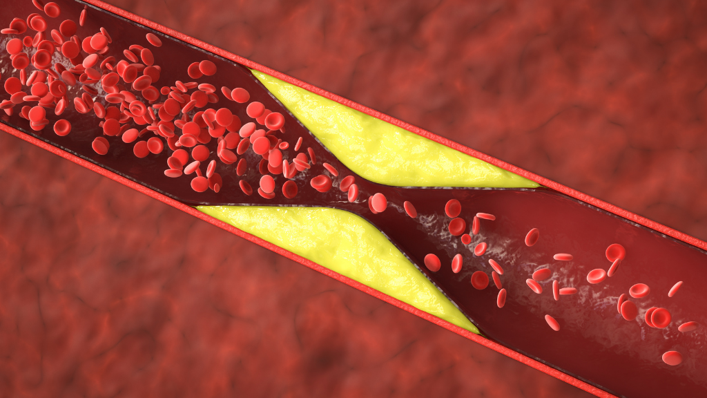 Nếu lòng mạch bị hẹp nhiều, bác sĩ có thể chỉ định đặt stent để tái thông dòng máu