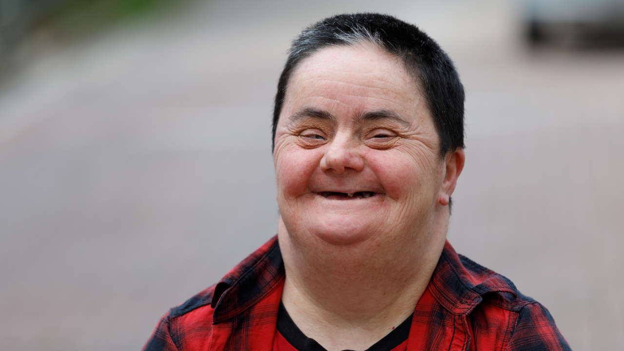 Hội chứng Down khi người bệnh thừa một bản sao nhiễm sắc thể số 21