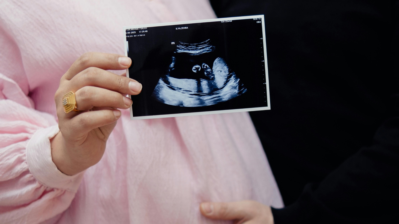 Double test tuần 12 kết quả đánh giá nguy cơ bất thường nhiễm sắc thể