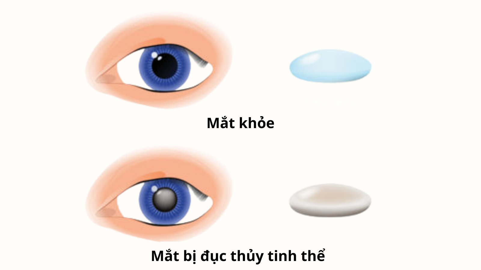 Đục thủy tinh thể người già  là nguyên nhân phổ biến nhất gây giảm thị lực ở người trên 65 tuổi