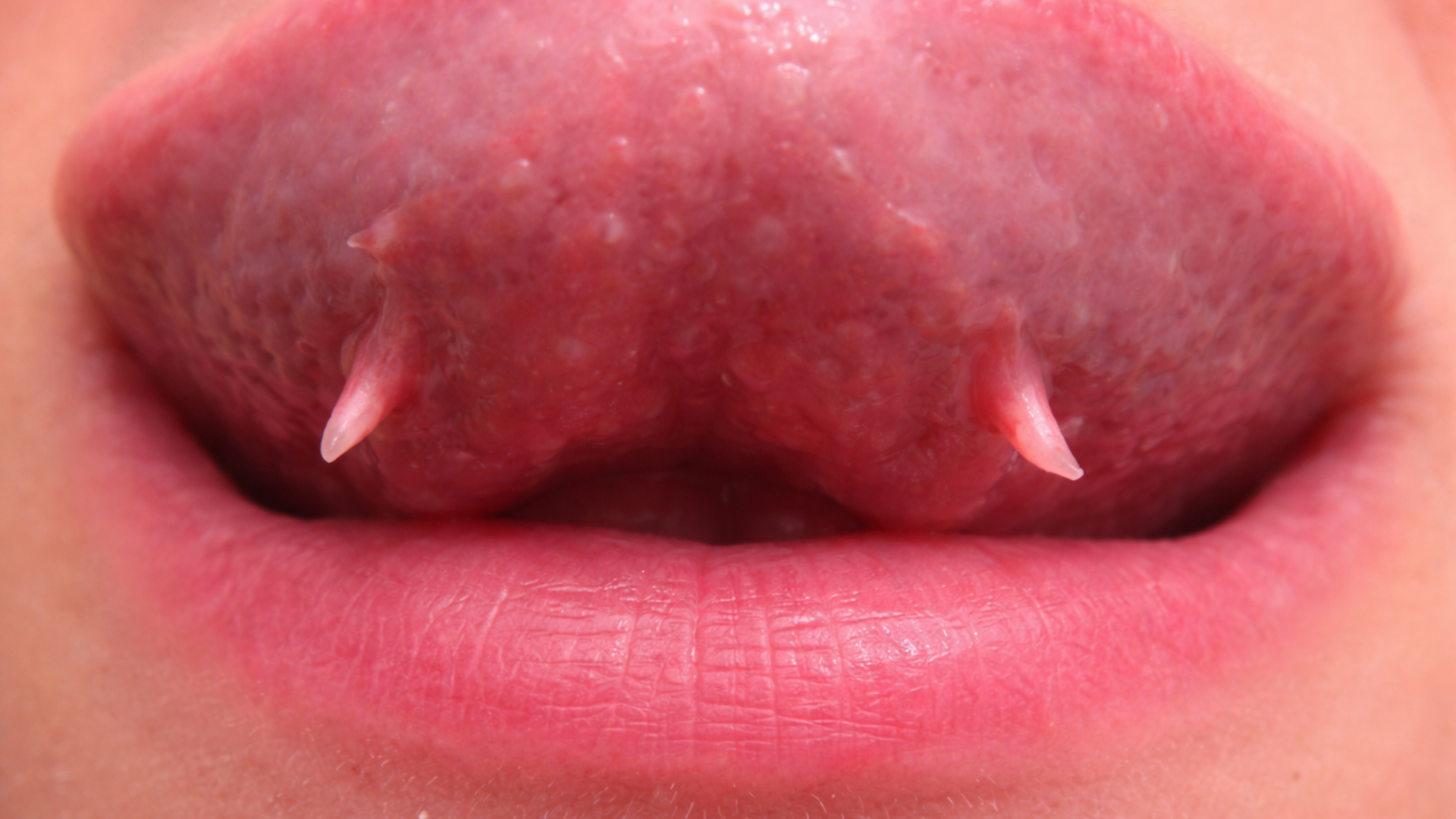 Hình minh họa cấu trúc dưới lưỡi có sợi thịt