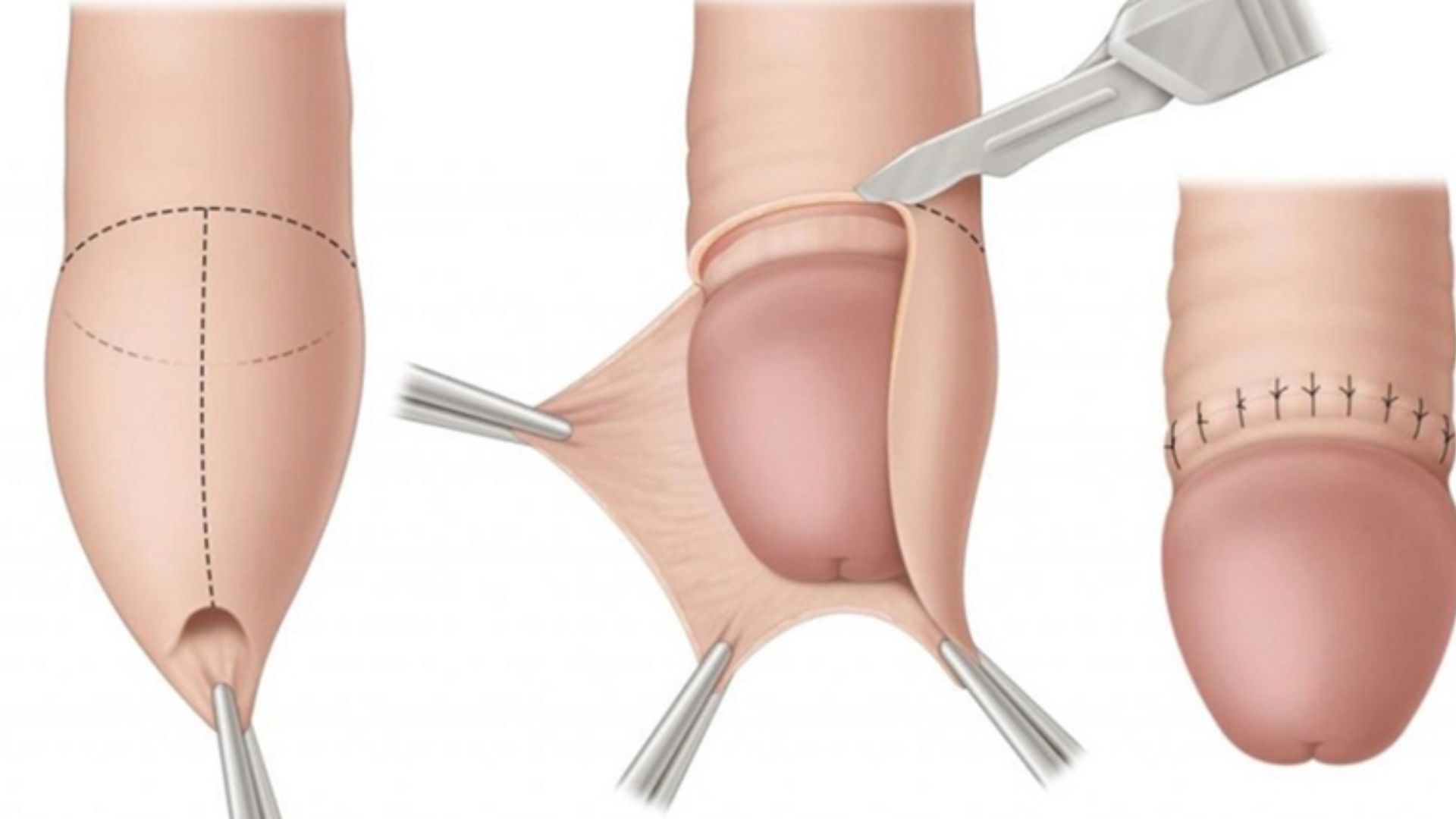 Dương vật sau khi cắt bao quy đầu trông sẽ sạch sẽ và gọn gàng hơn