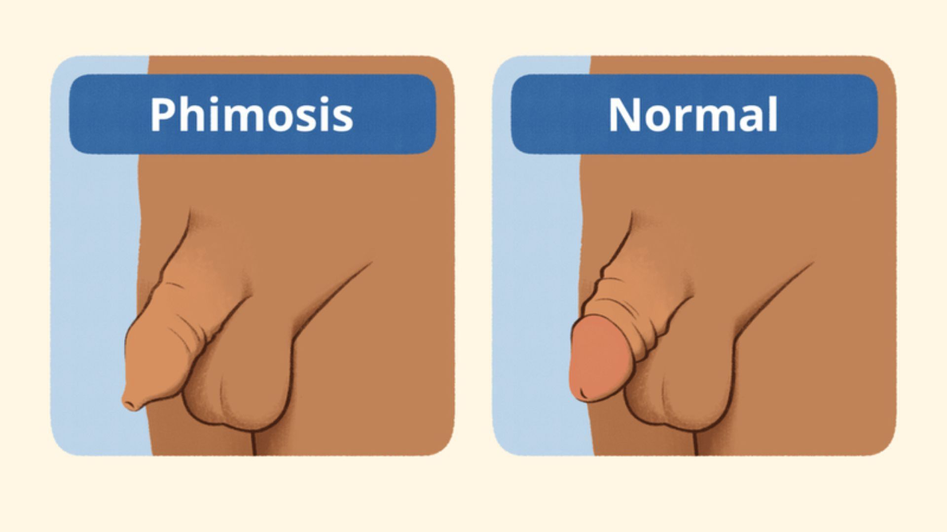 Cắt bao quy đầu sẽ được chỉ định trong trường hợp hẹp bao quy đầu