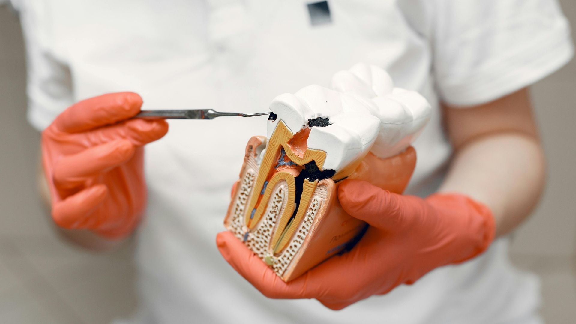 Tổn thương răng có thể gây tình trạng ê buốt