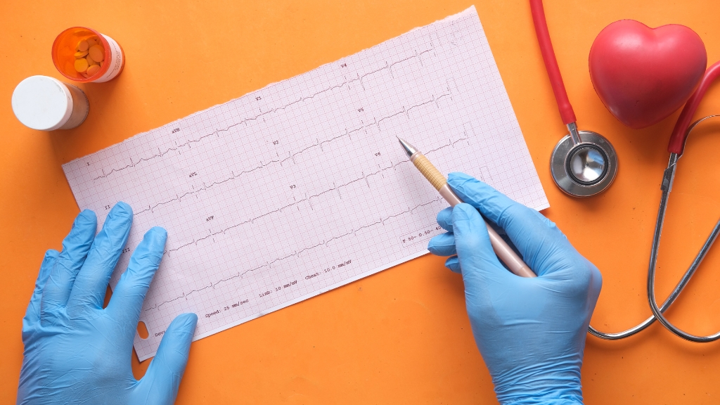 ECG nhồi máu cơ tim là gì? Dấu hiệu nhận biết và ý nghĩa trong cấp cứu 2