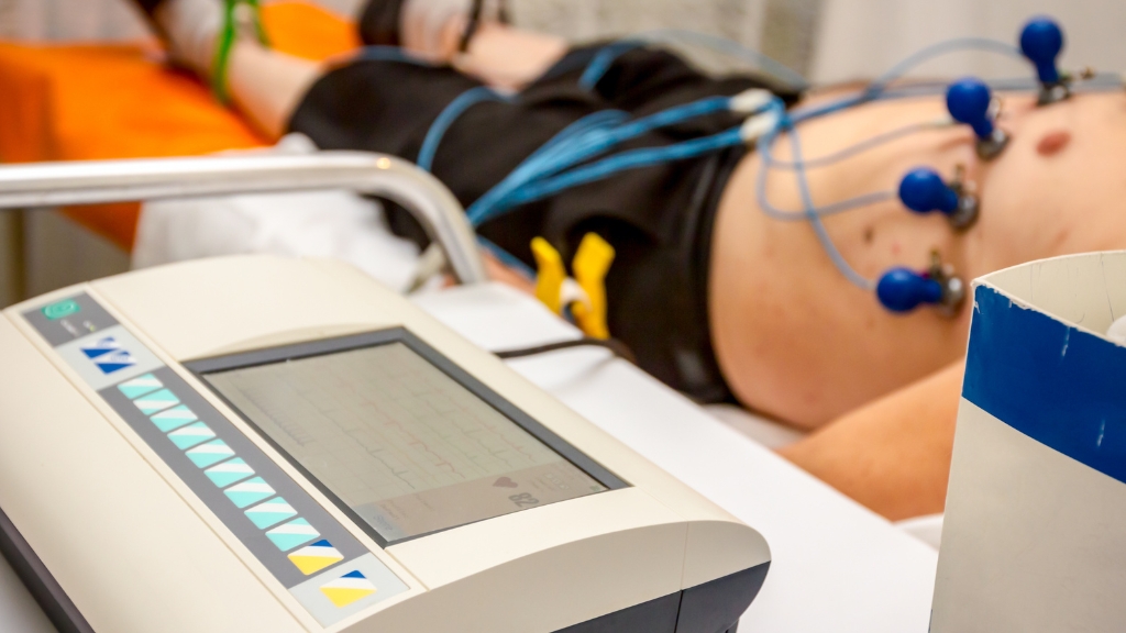 ECG nhồi máu cơ tim là gì? Dấu hiệu nhận biết và ý nghĩa trong cấp cứu 4