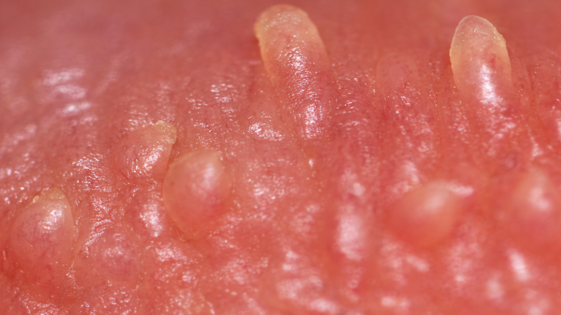 Gai sinh dục có tự hết không là thắc mắc phổ biến khi thấy nhú nhỏ vùng kín