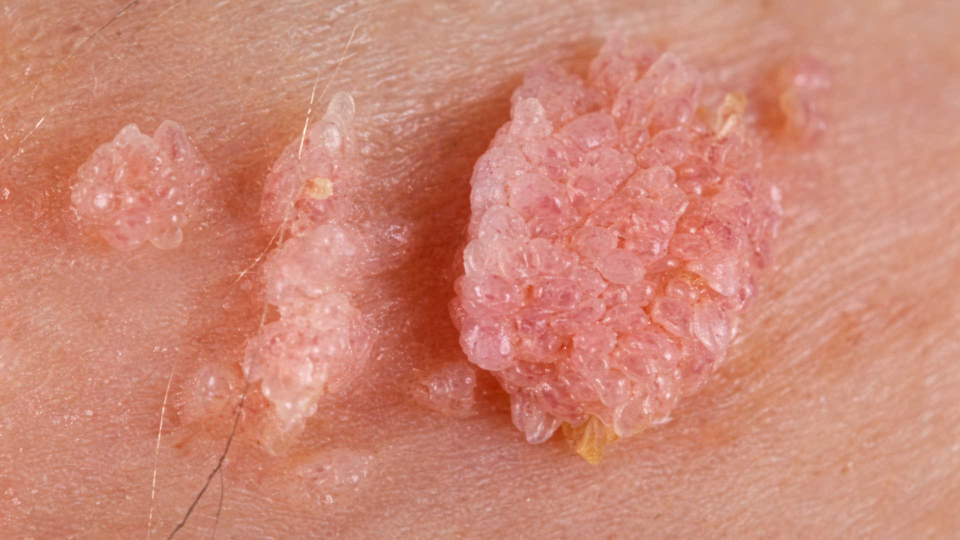 Các nhú gai nhỏ li ti là đặc điểm thường thấy của gai sinh dục