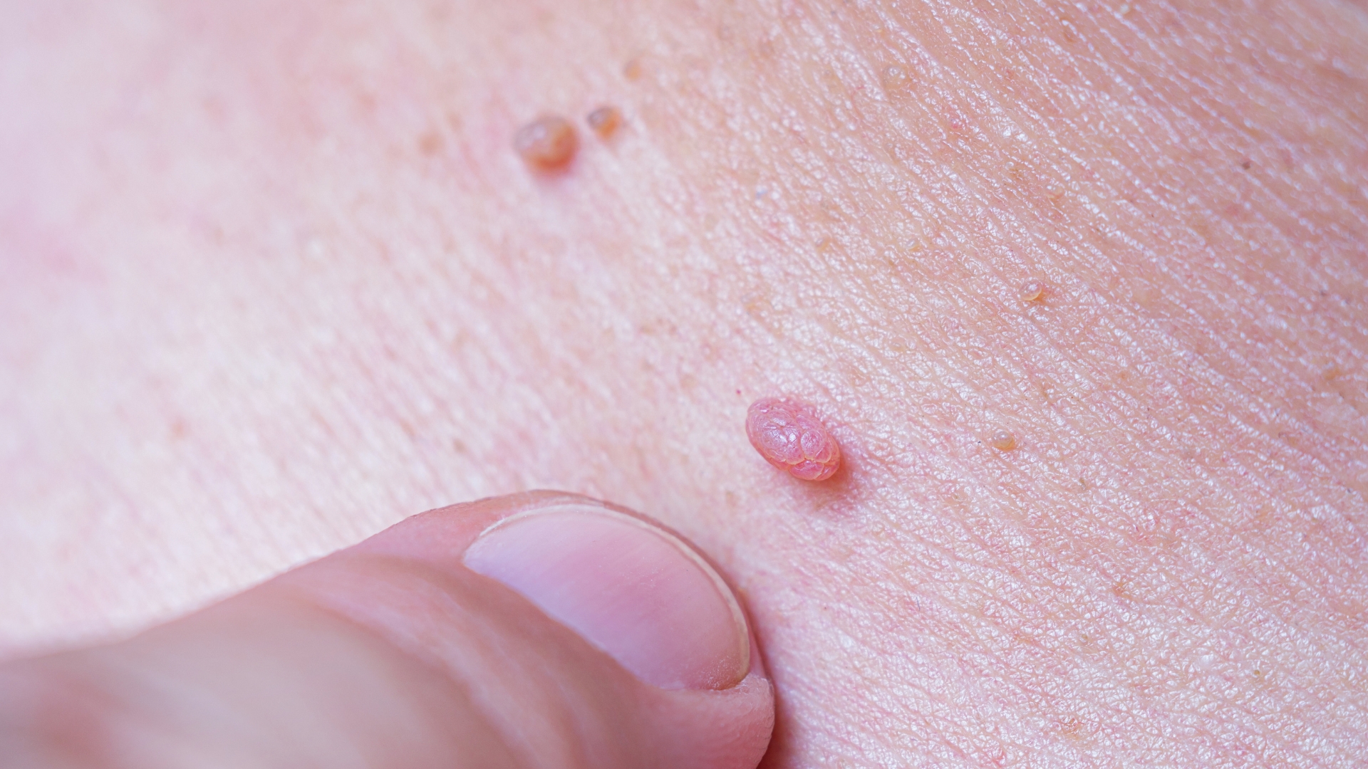 Các nhú có thể mọc riêng lẻ hoặc xếp thành hàng