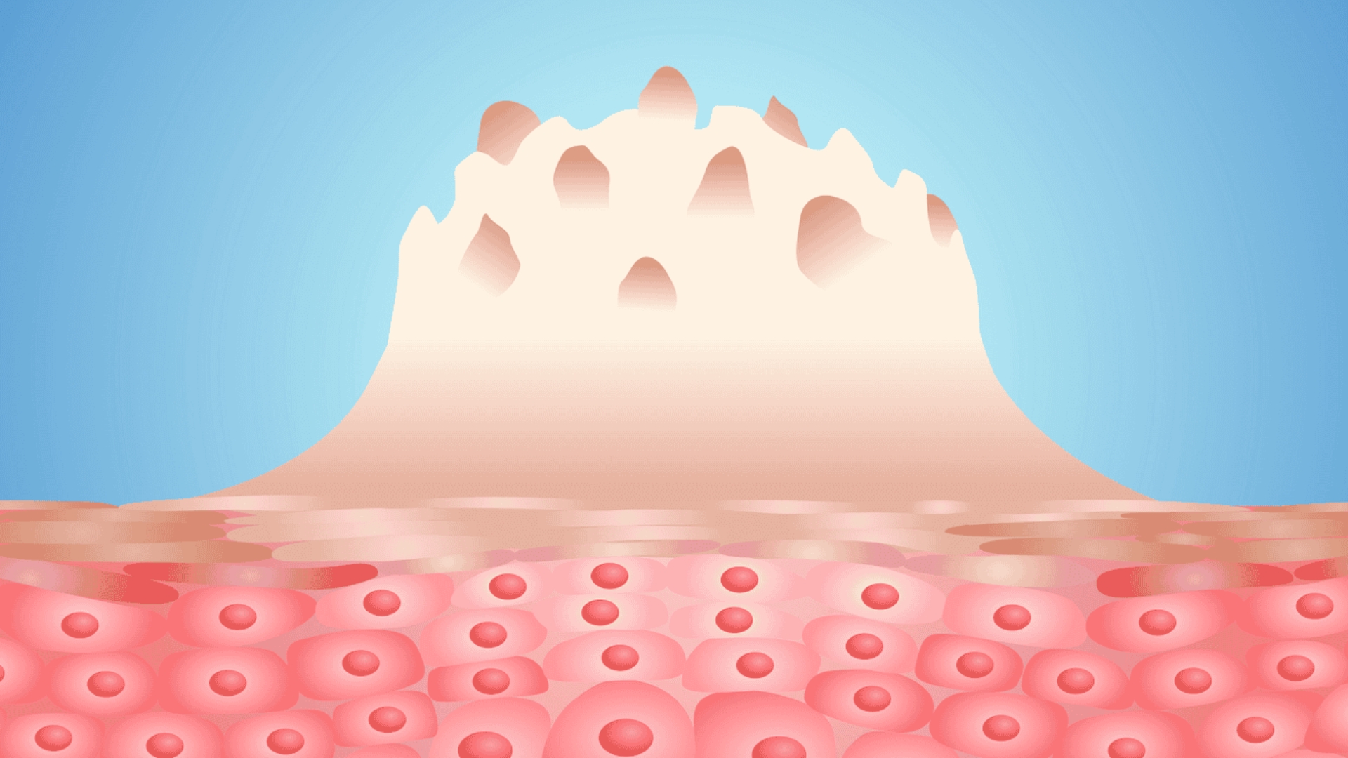 Cần phân biệt gai sinh dục với sùi mào gà