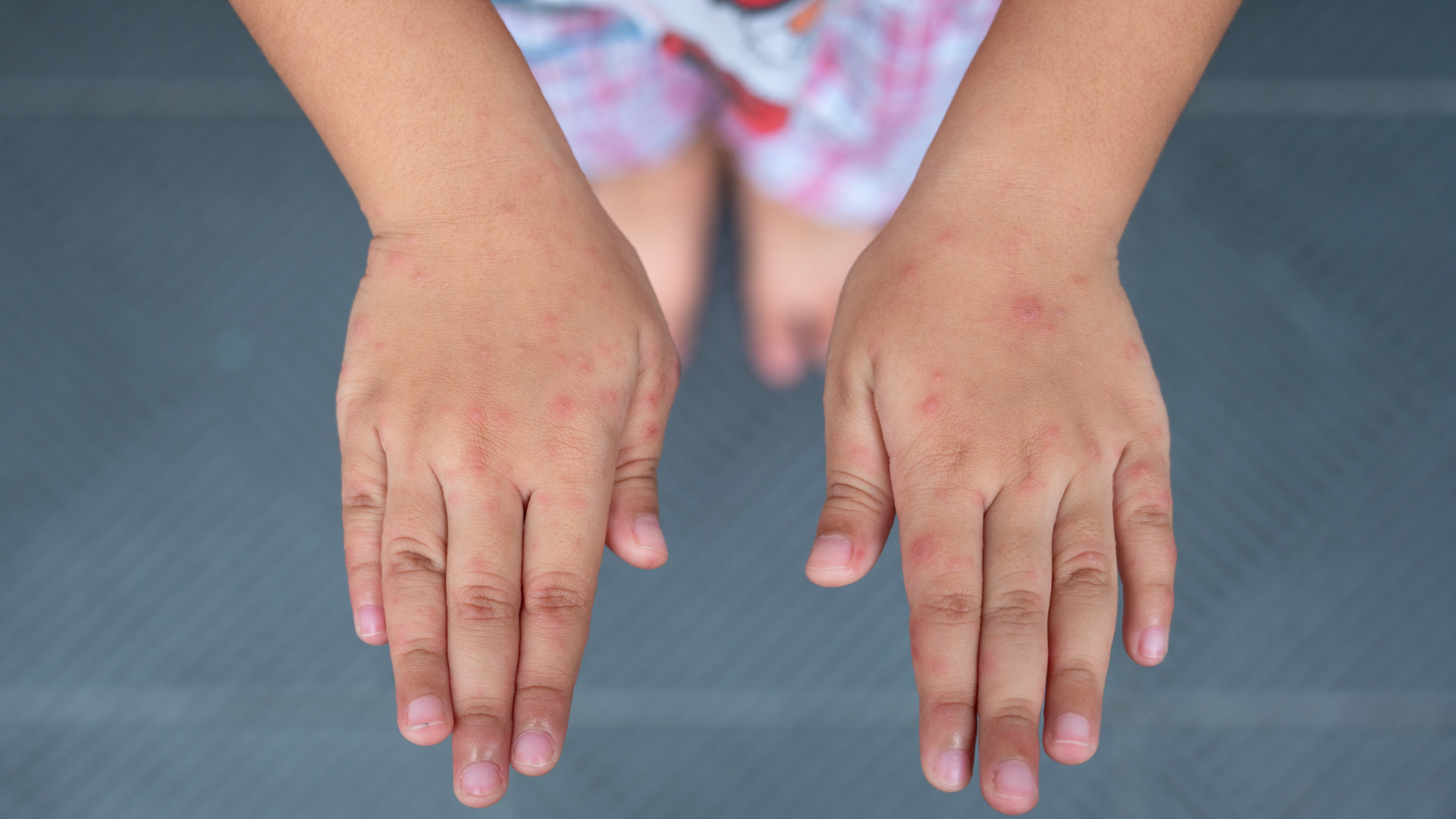 Gần 3.000 trẻ mắc trong 2 tháng là dấu hiệu cảnh báo tỉ lệ tay chân miệng tăng cao