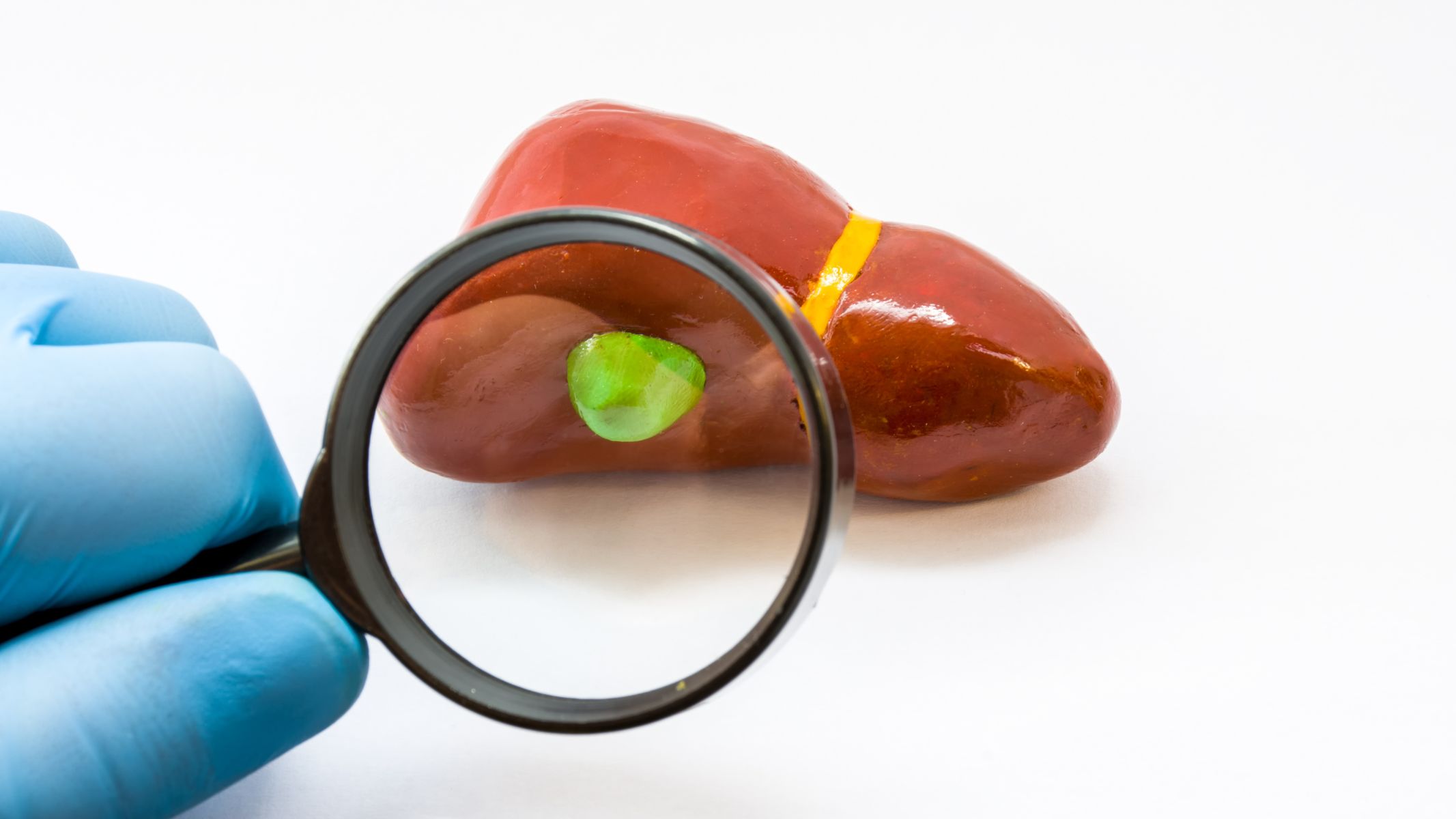 Gan nhiễm mỡ và polyp túi mật là gì?