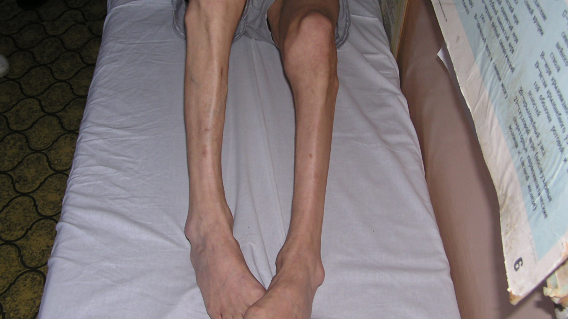 Sau gãy cổ xương đùi, bệnh nhân có thể gặp một số biến chứng như teo cơ