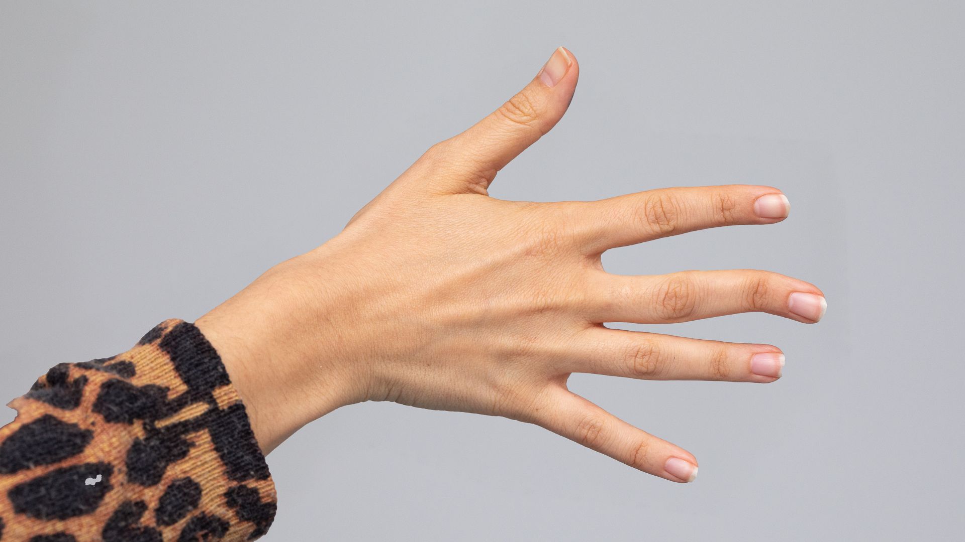 Mức độ gãy và tình trạng gãy xương là yếu tố ảnh hưởng đến thời gian lành khi bị gãy đốt ngón tay