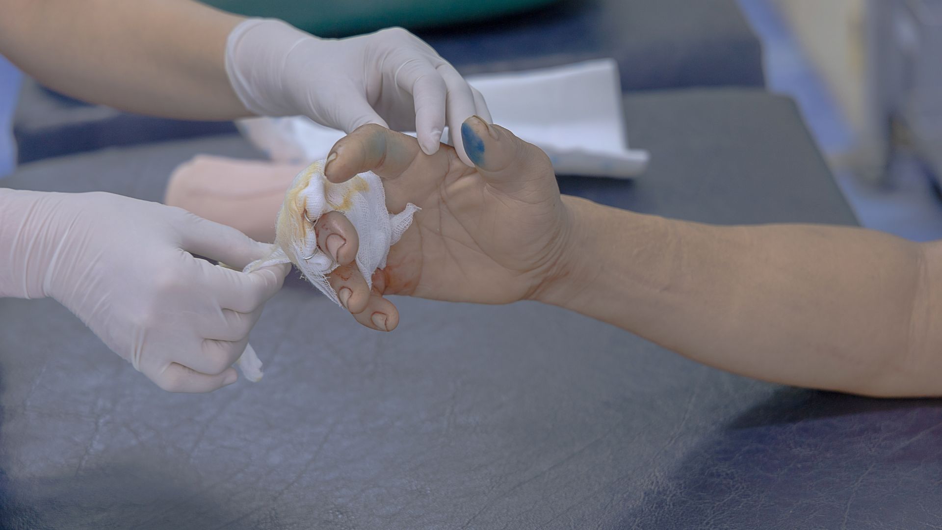 Tốc độ liền xương còn phụ thuộc vào tuổi tác và tình trạng sức khỏe chung của người bệnh