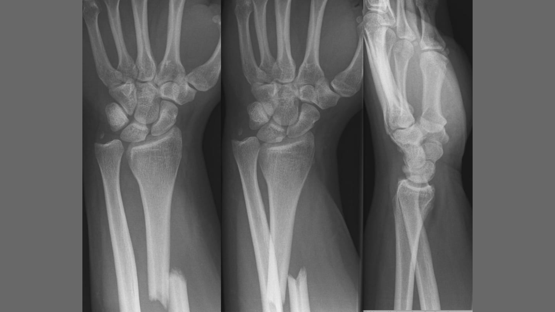 Gãy Galeazzi là một dạng chấn thương phức tạp của cẳng tay, là tình trạng gãy thân xương quay ở đoạn một phần ba dưới kèm theo trật khớp quay - trụ dưới