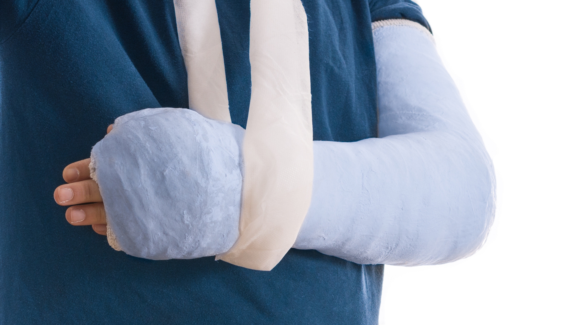 Sau phẫu thuật, bệnh nhân cần được bất động tạm thời cẳng tay bằng nẹp hoặc bột trong vài tuần để bảo vệ ổ gãy và khớp vừa được ổn định