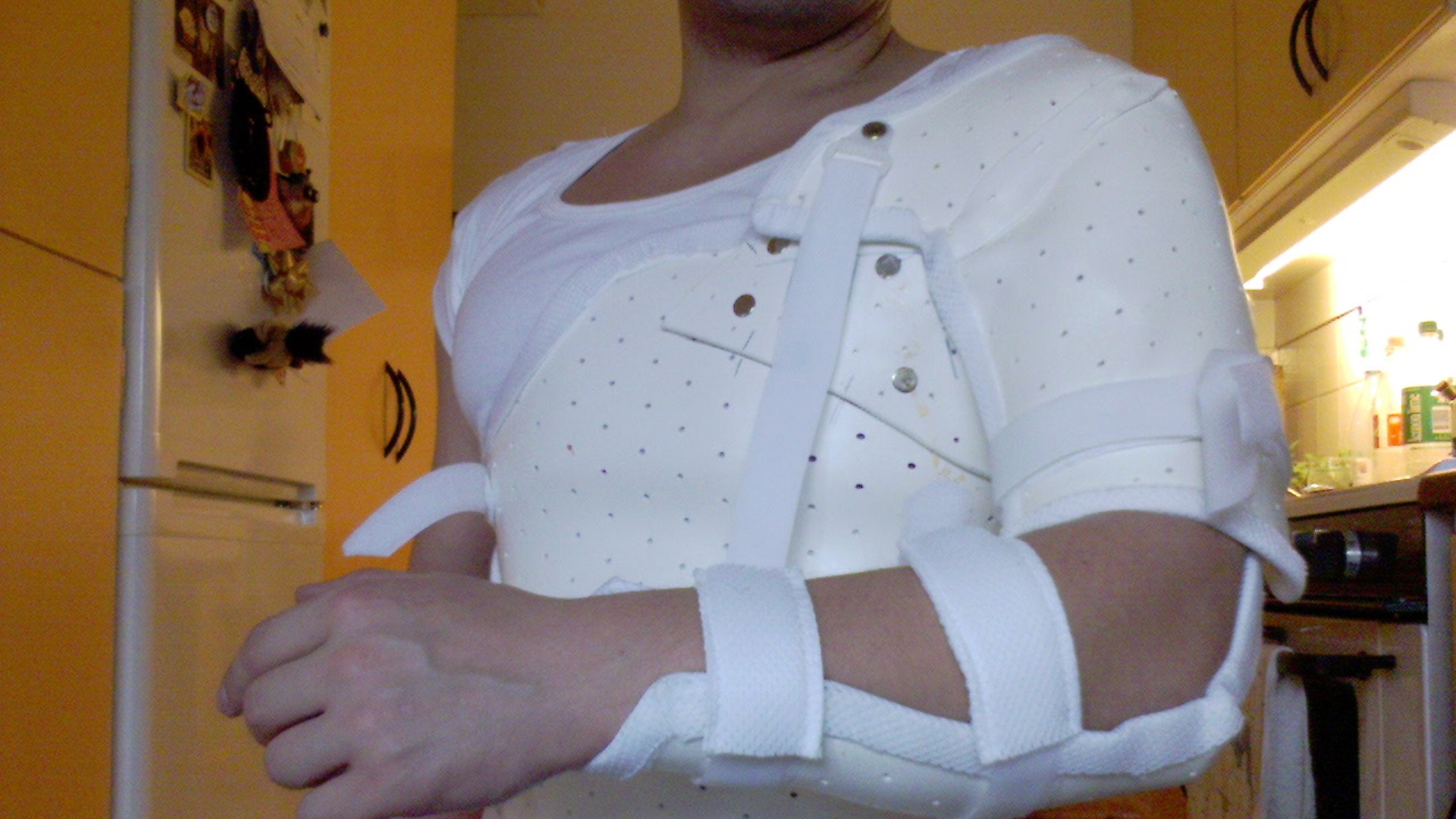 Bệnh nhân sẽ được bất động chi bằng nẹp U, nẹp giọt nước hoặc bột treo vai - cẳng tay trong thời gian khoảng 6 - 8 tuần