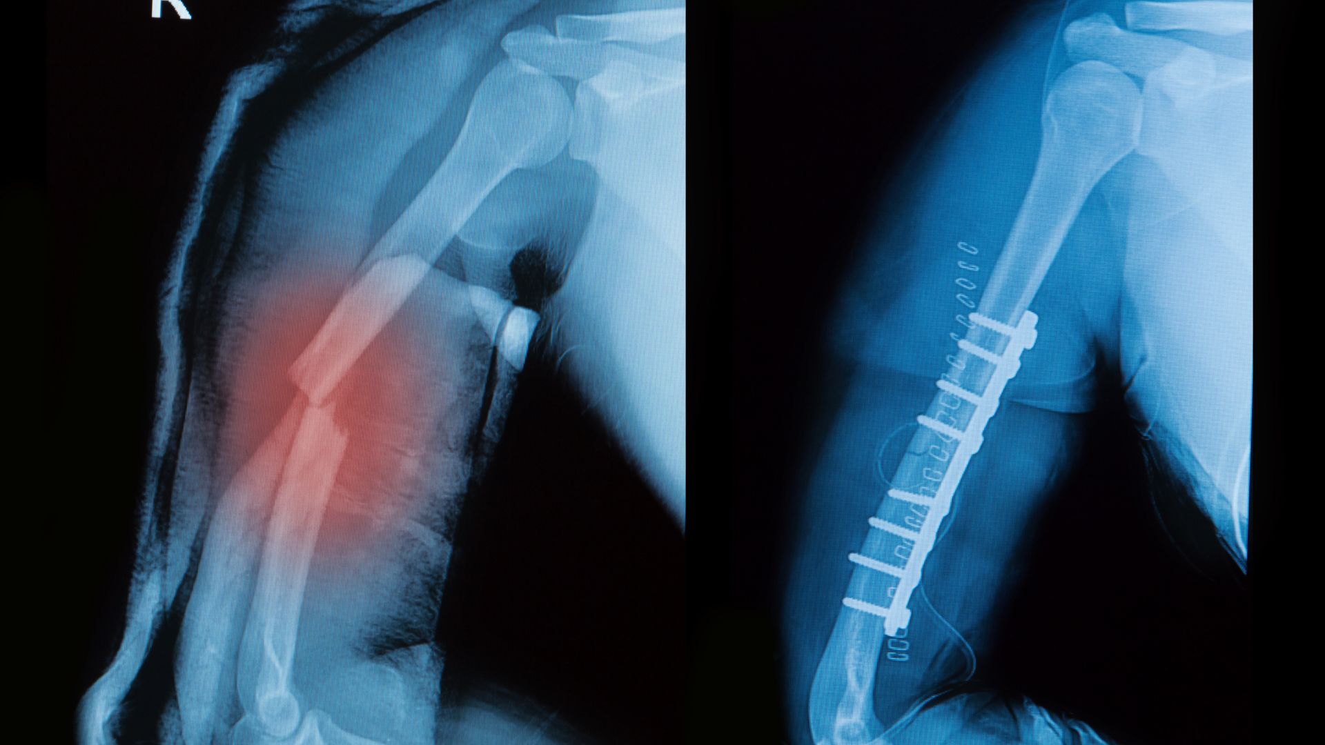 Gãy trên lồi cầu xương cánh tay có thể gây tổn thương mạch máu và thần kinh