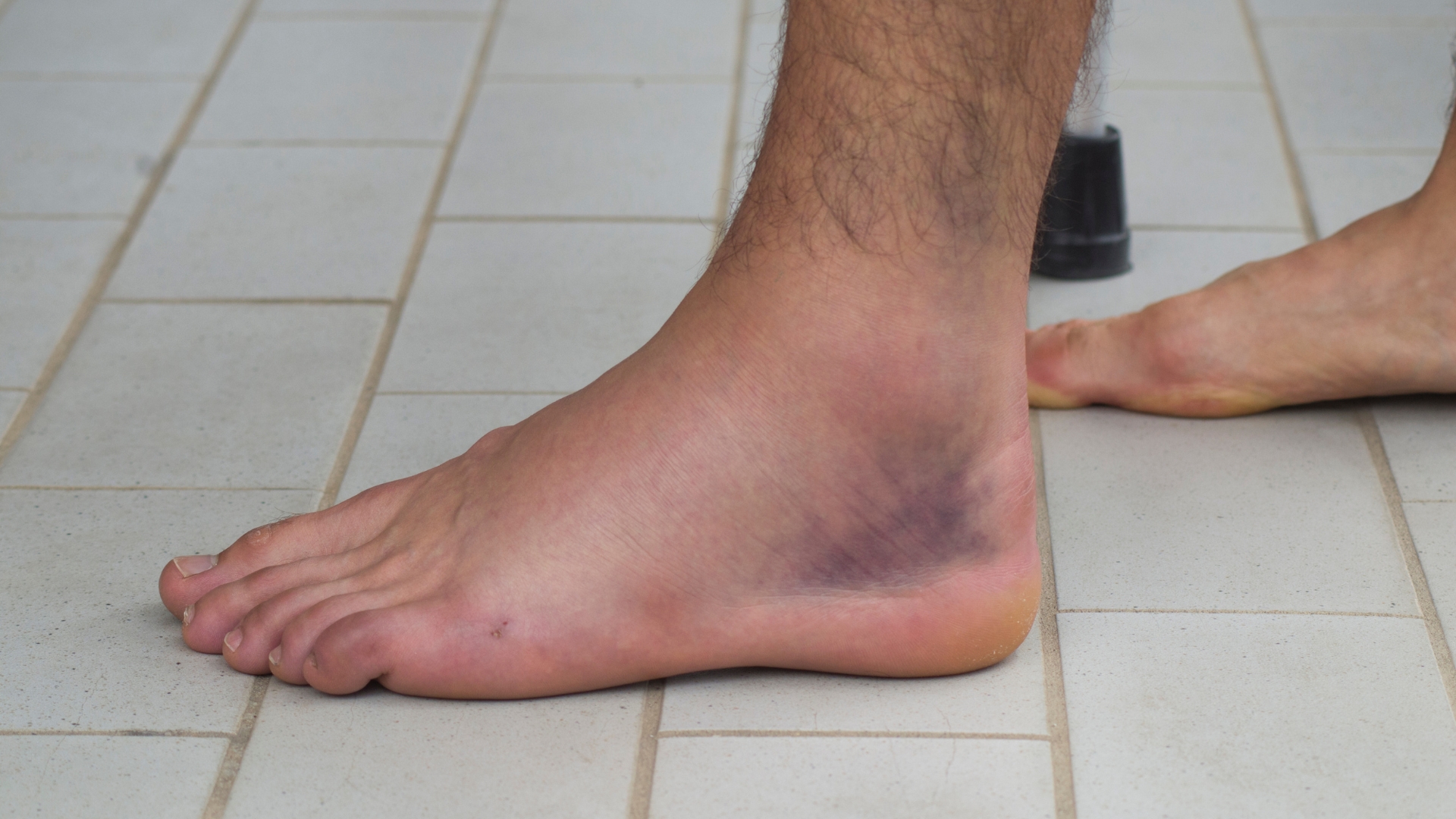 Sưng là phản ứng viêm tự nhiên của cơ thể, xuất hiện nhanh chóng sau chấn thương gãy xương bàn chân