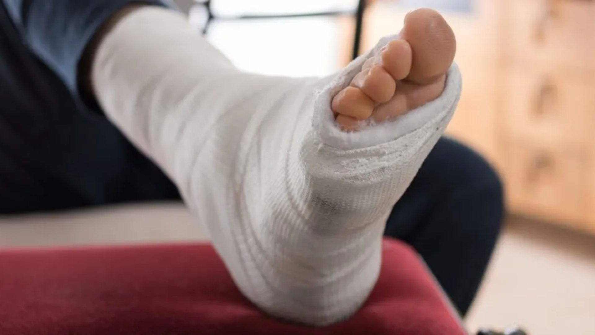 Gãy xương bàn chân số 5 bó bột bao lâu còn phụ thuộc loại gãy và tình trạng sức khỏe