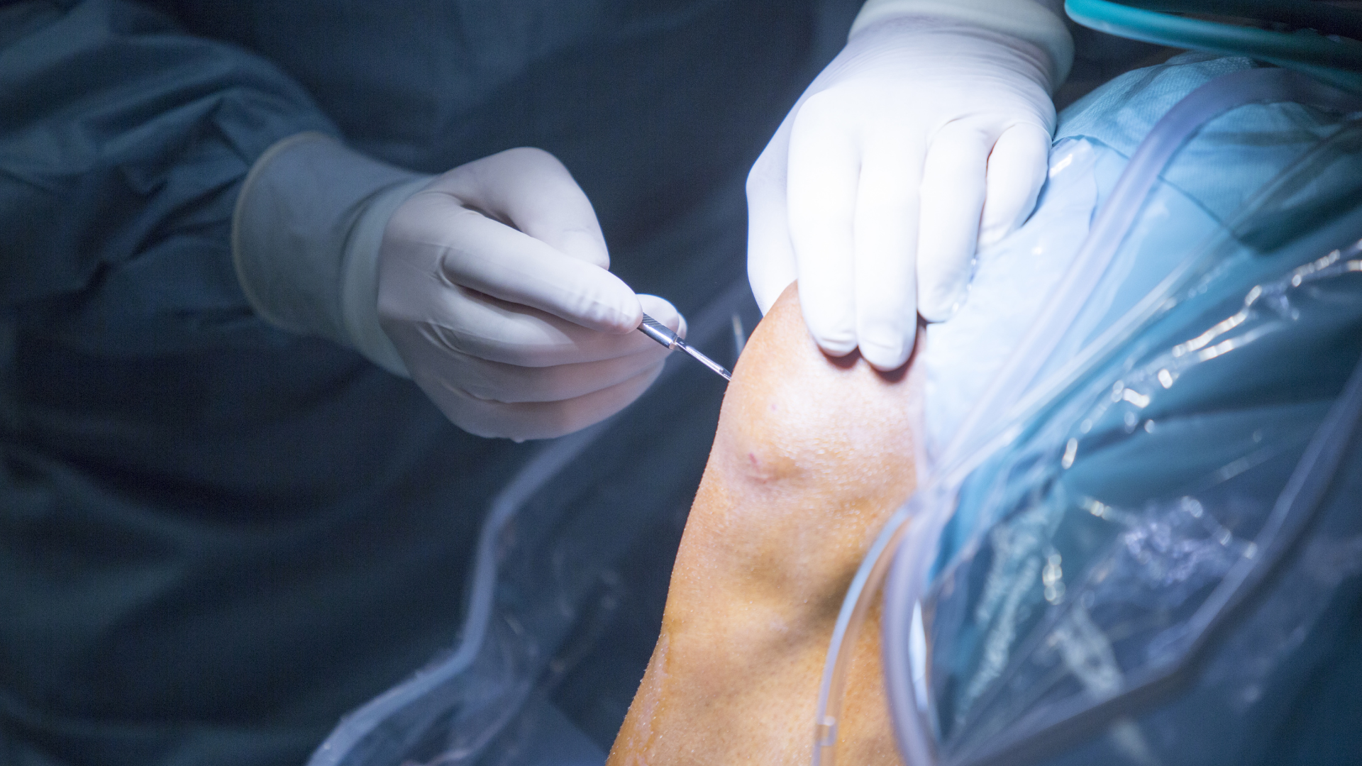 Phẫu thuật kết hợp xương bằng vít, nẹp hoặc khâu phục hồi gân bánh chè