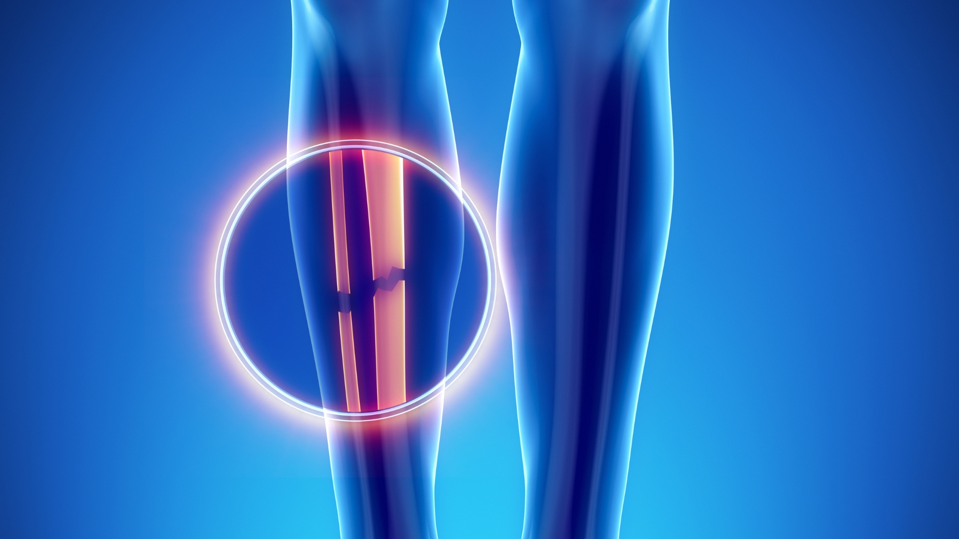 Gãy xương cẳng chân là tình trạng gãy hoặc nứt một hoặc cả hai xương dài nằm giữa gối và cổ chân