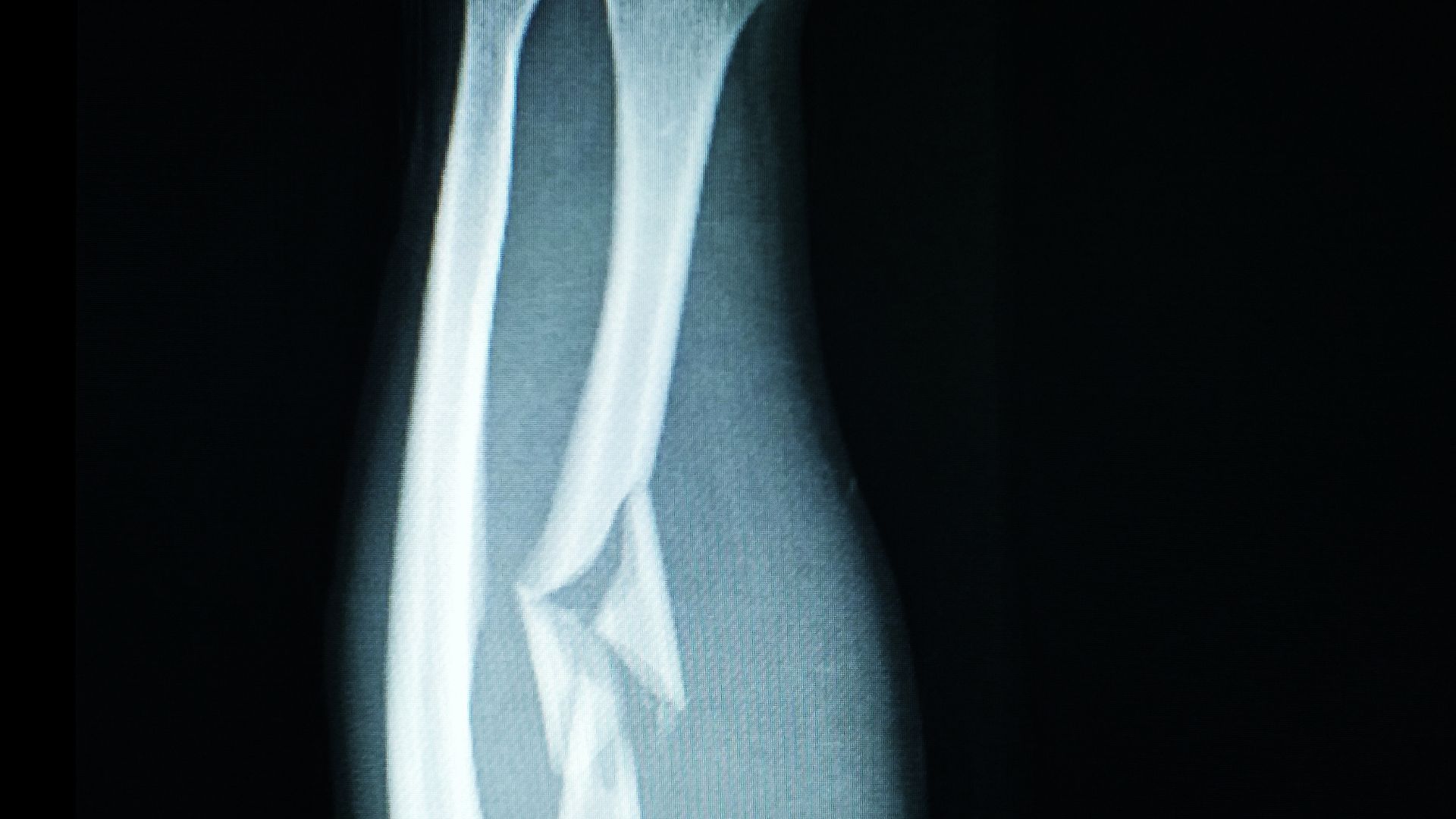 Gãy xương cẳng tay là một chấn thương có thể gặp ở bất kỳ lứa tuổi nào