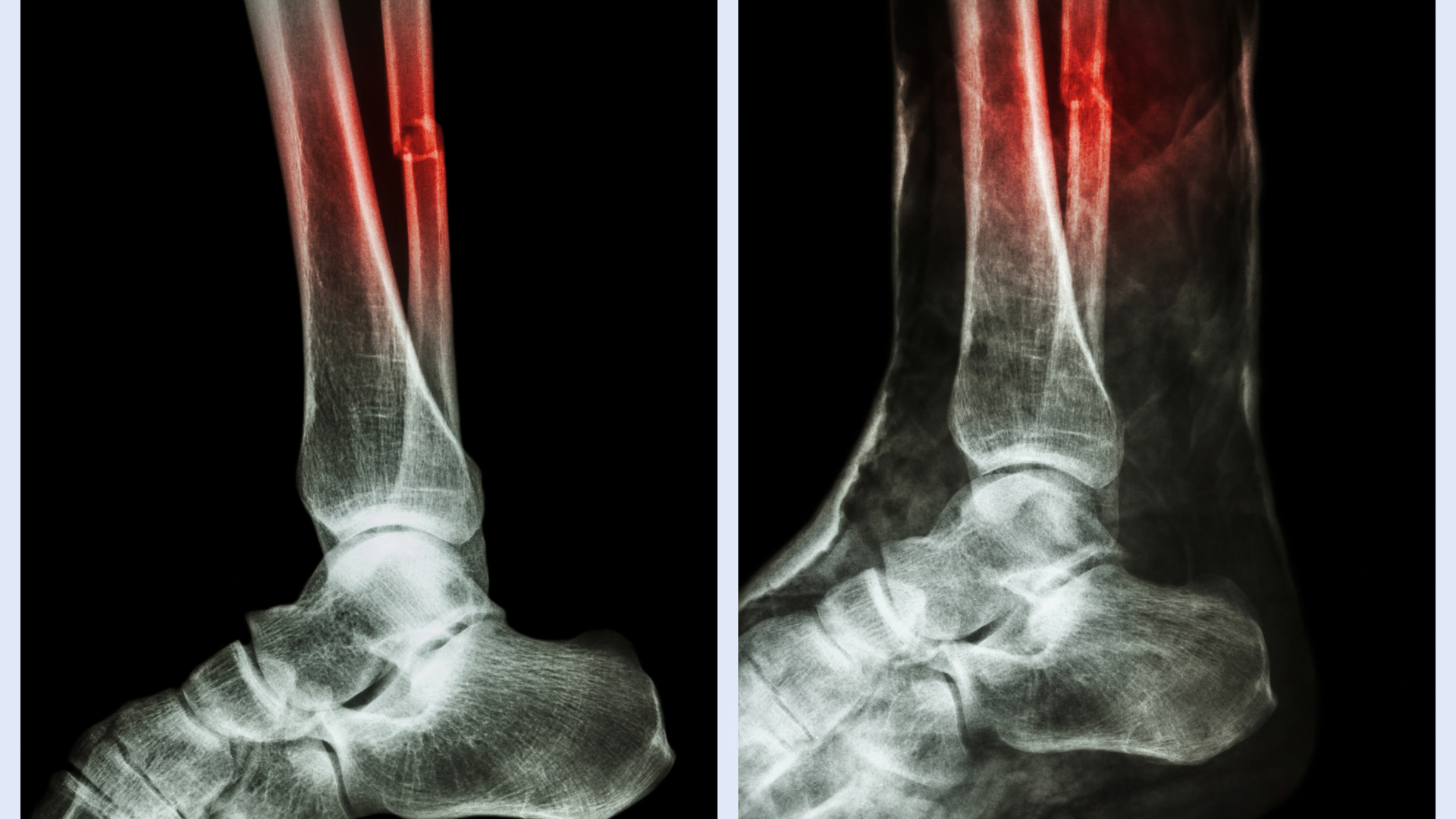 Gãy xương mác chiếm khoảng 16 - 20% tổng số các trường hợp gãy chi dưới