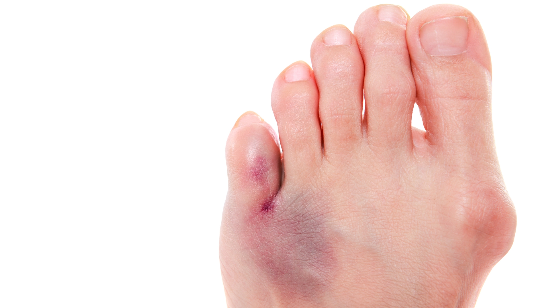 Tình trạng sưng nề lan rộng kèm theo đổi màu da thường liên quan đến chấn thương nghiêm trọng ở mô mềm hoặc xương