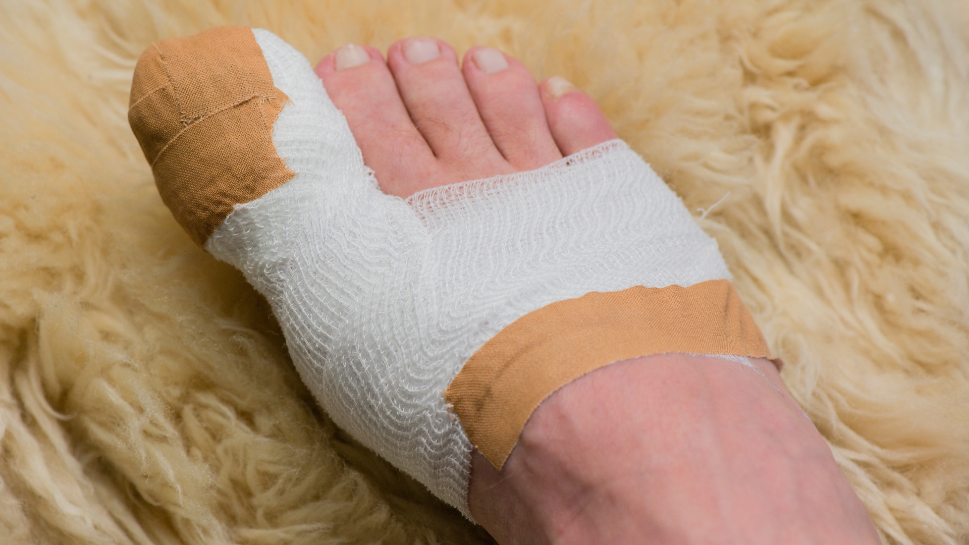 Khi có dấu hiệu gãy gần khớp hoặc xương có nguy cơ di lệch, bó bột có thể được áp dụng để giữ cố định